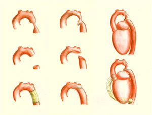 Patch Aortoplasty Coarctation Aorta