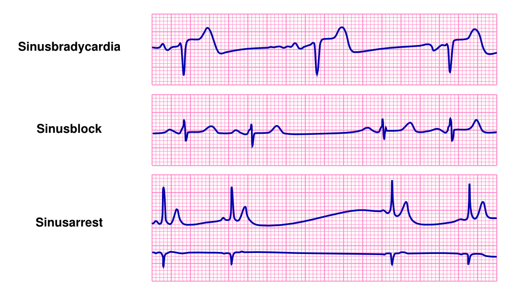 Брадикардия мкб. Синус брадикардия. Sinus exit Block. Av Nodal Rhythm. Bradycardia произношение.