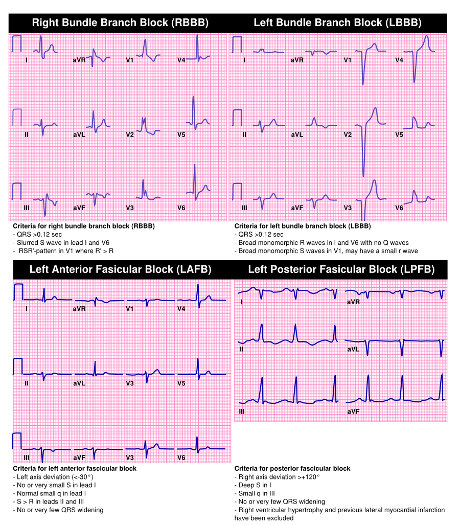 Bradycardia - Textbook of Cardiology