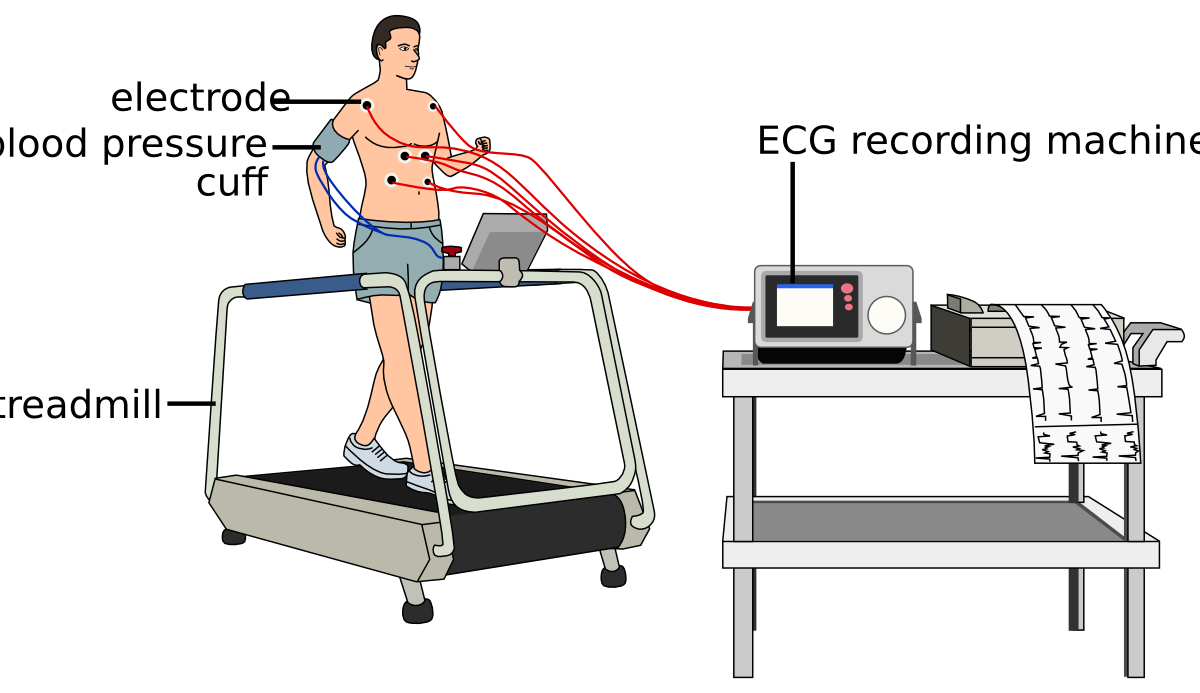 file-exercise-test-svg-textbook-of-cardiology