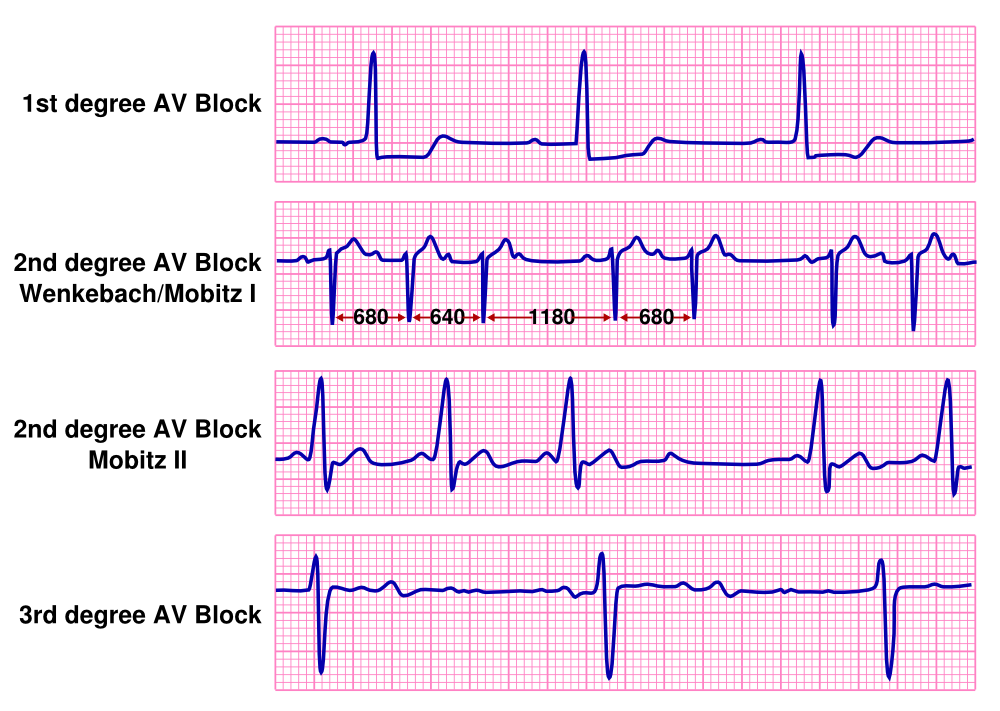 Степень st 3. Av Block ECG 2 degree. 3rd degree av Block ECG. Av Block ECG 1 degree. ECG av Block 3.